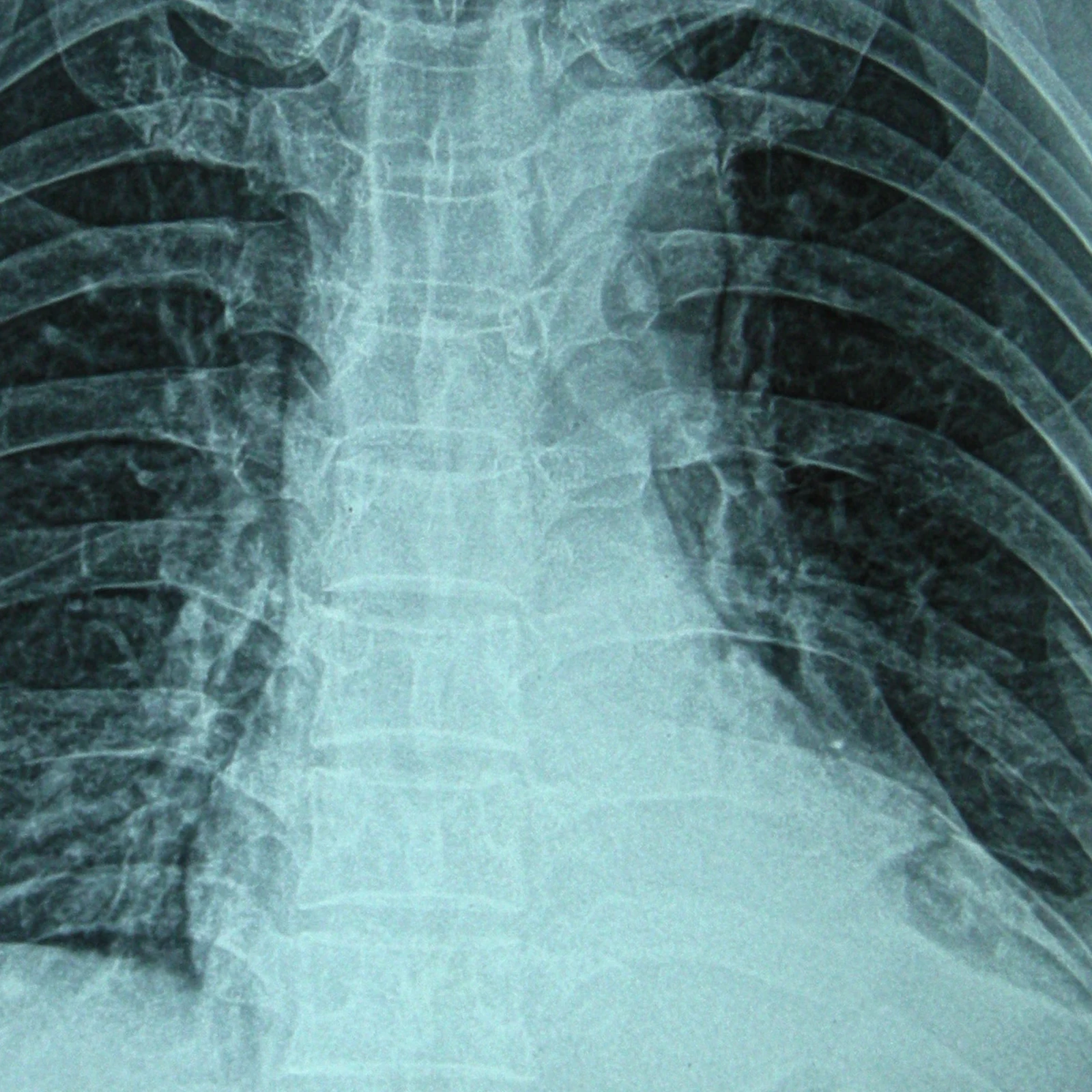 갈비뼈골절 합의금 판단에 참고할 수 있는 흉부 X-ray 설명 이미지